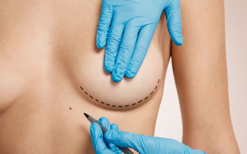 Breast Augmentation or Lift