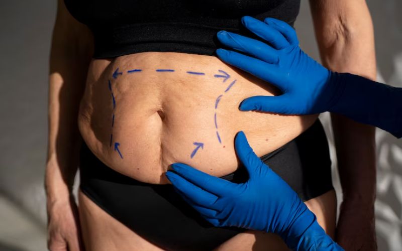 Liposuction